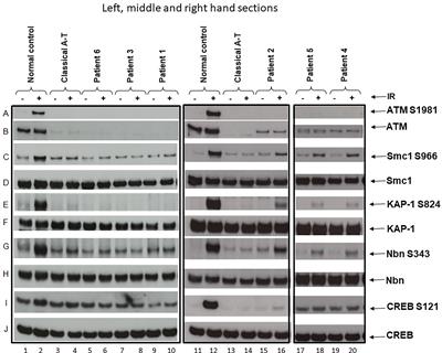 Childhood-Onset Movement Disorders Can Mask a Primary Immunodeficiency: 6 Cases of Classical Ataxia-Telangiectasia and Variant Forms